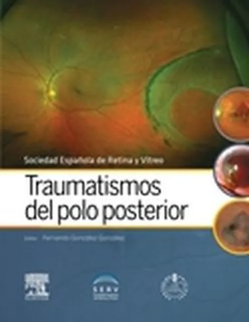 Traumatismos del polo posterior + acceso web