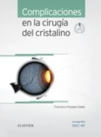 Complicaciones en la cirugía del cristalino + acceso web