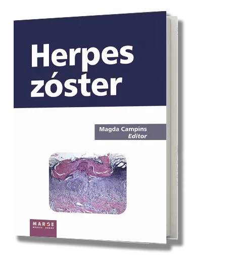 HERPES ZOSTER